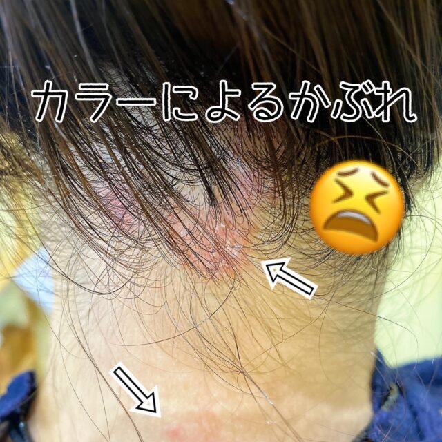 ご自分で白髪染めをして かぶれちゃったお客様😢

アレルギーなんですね🤔

アレルギー対応のカラー
あります

#アレルギー対応#アレルギー#ジアミンアレルギー

hi-z hair
横浜市都筑区中川中央1-22-11 エミリオ1F
045-532-6226

#美容室#ショートカット#個室サロン#一人営業サロン#大人のプライベートサロン#こだわりの美容室#艶カラー#炭酸泉#炭酸泉スパ#電子トリートメント#美容室ジプシー#アンチエイジング#センター北#センター北美容室#都筑区#イルミナカラー#フローディアトリートメント#ノンジアミンカラー#ケアプロ#ムコタトリートメント#オラプレックス#ジアミンかぶれ#カラーかぶれ#一人美容室